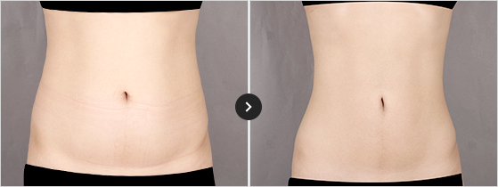 365mc BEFORE & AFTER