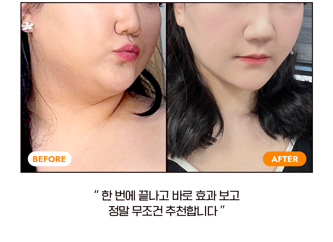 before after