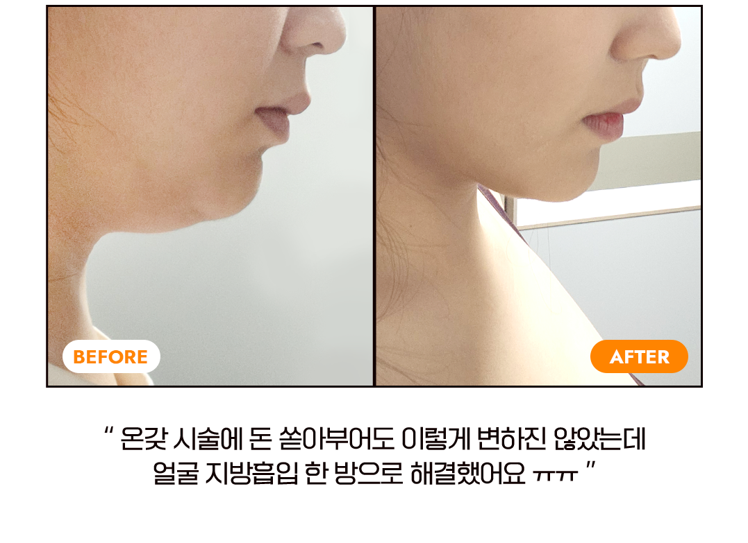 before after