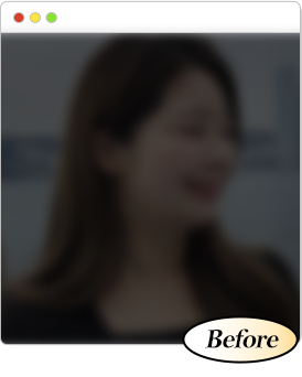 이중턱 지방흡입 수술 전