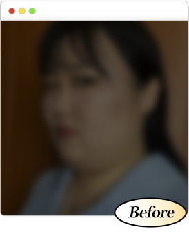 볼+이중턱 지방흡입 수술 전