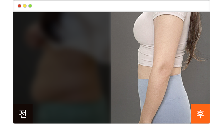 복부 지방흡입 5주차 전후사진