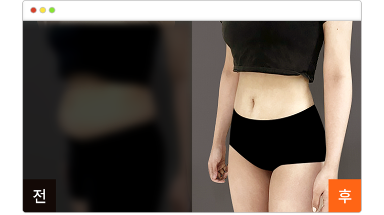 복부 지방흡입 7주차 전후사진