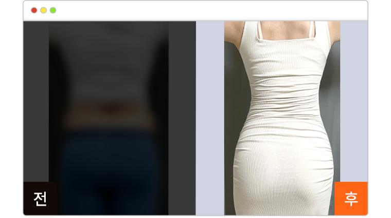 복부 지방흡입 1개월차 전후사진