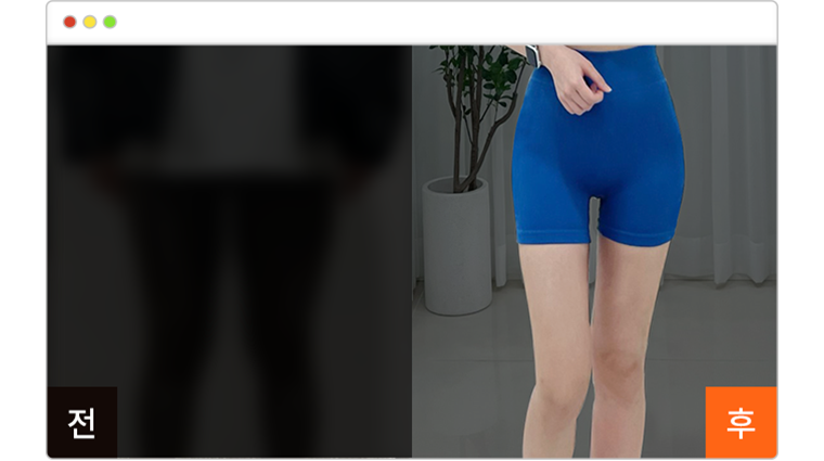 허벅지 지방흡입 6개월차 전후사진