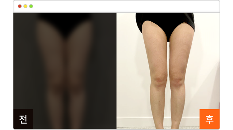 허벅지 지방흡입 3개월차 전후사진