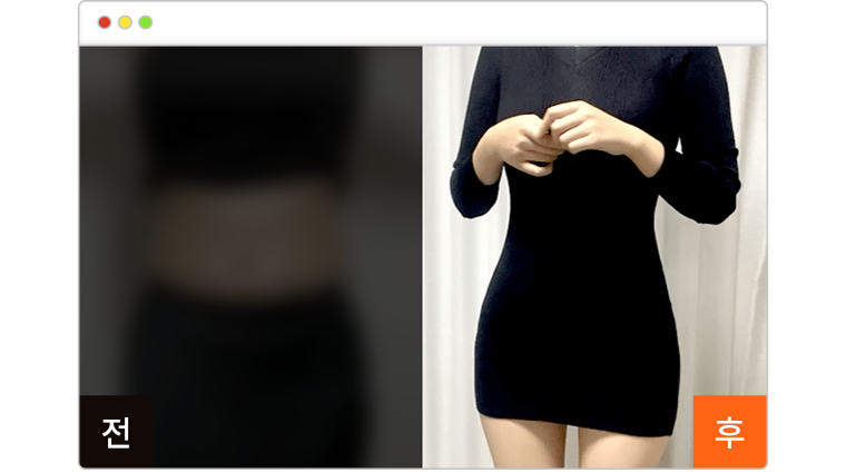 복부 지방흡입+골반 지방이식 1개월차 전후사진